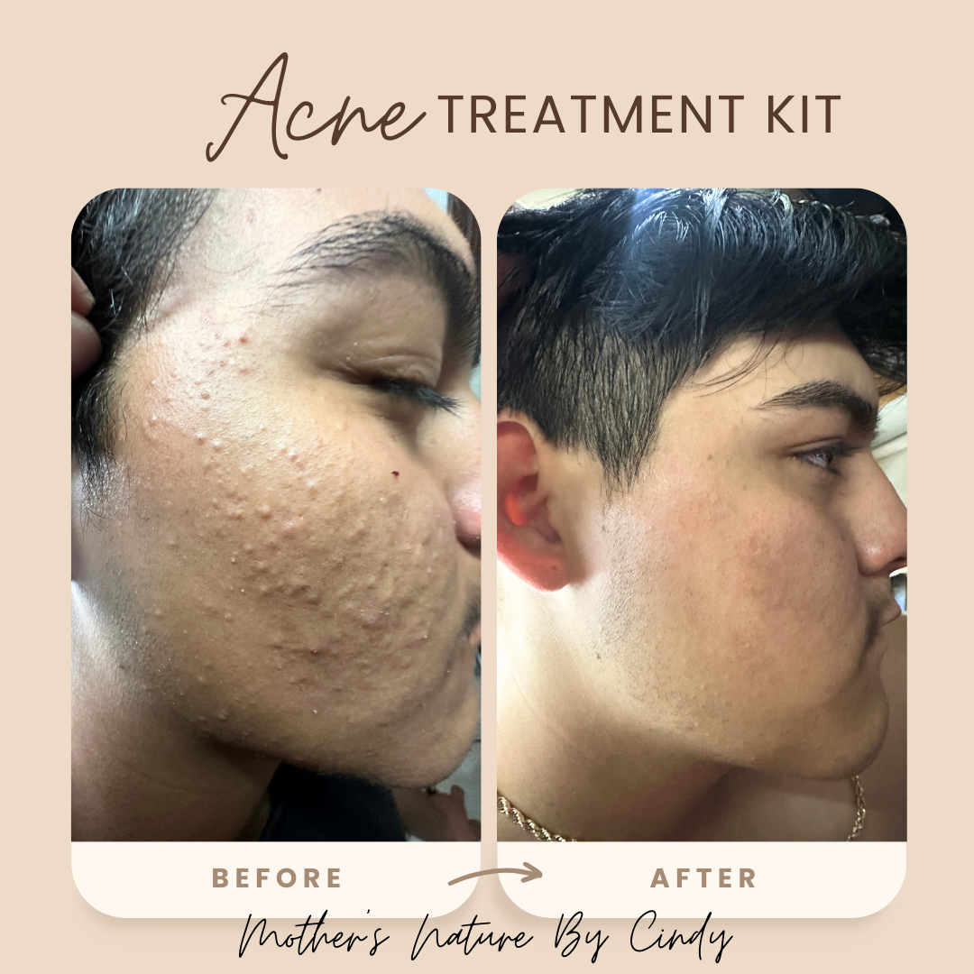 Acne Kit